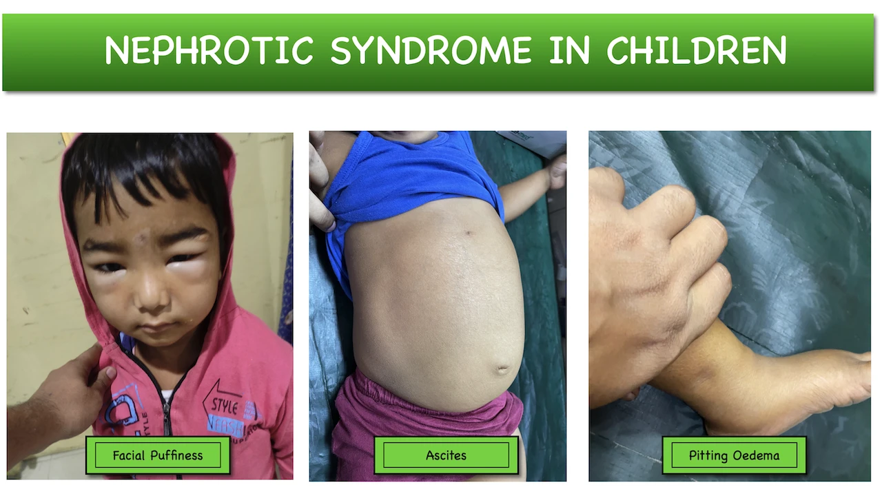 Nephrotic Syndrome in children – Causes | Clinical features ...